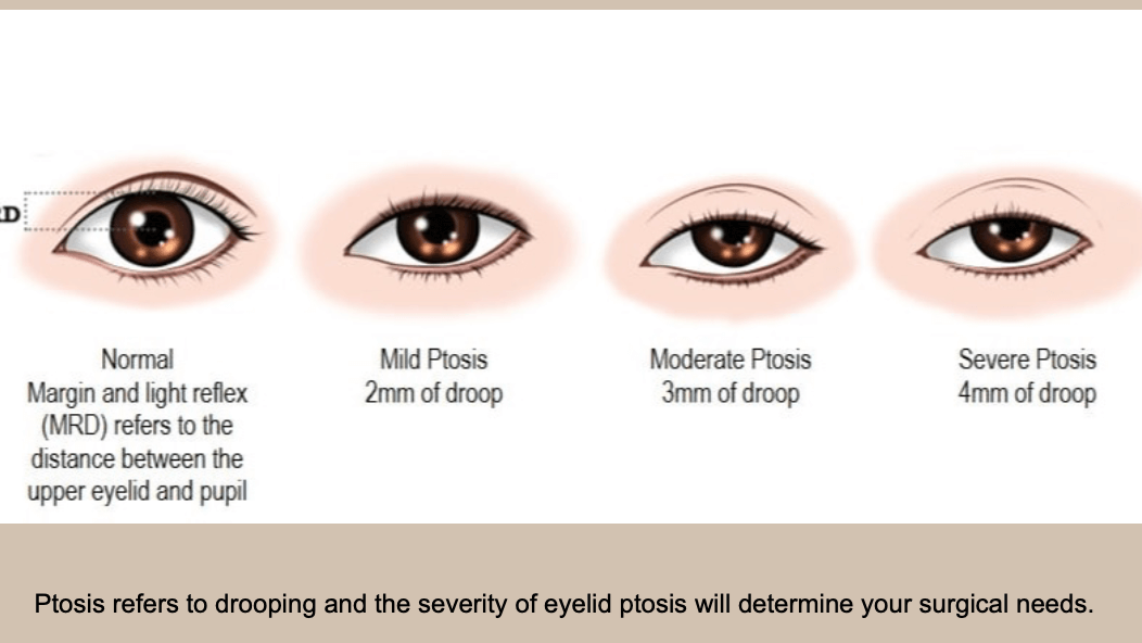 Ptosis